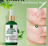 Uptown La – Anti-Acne Face Serum